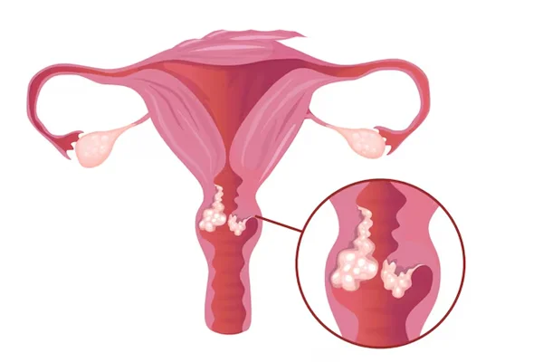Biopsy Endometrial or Cervical